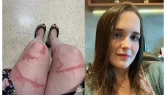 Jovem fica com cicatriz nas pernas após ser queimada por caravela-portuguesa: 'Parecia ferro