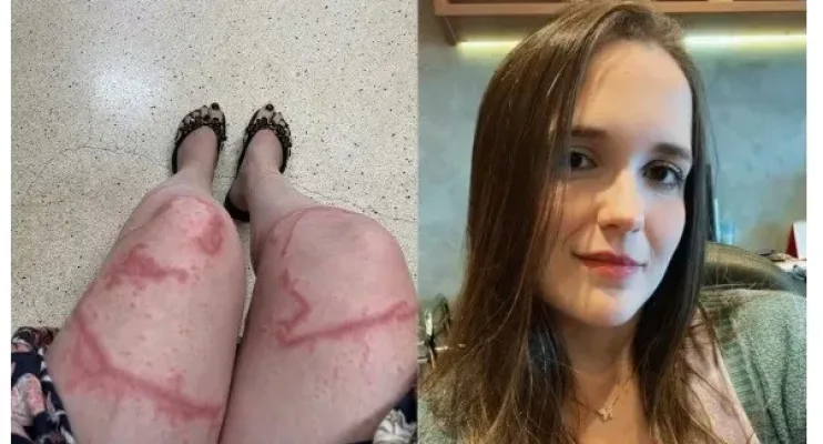 Jovem fica com cicatriz nas pernas após ser queimada por caravela-portuguesa: 'Parecia ferro