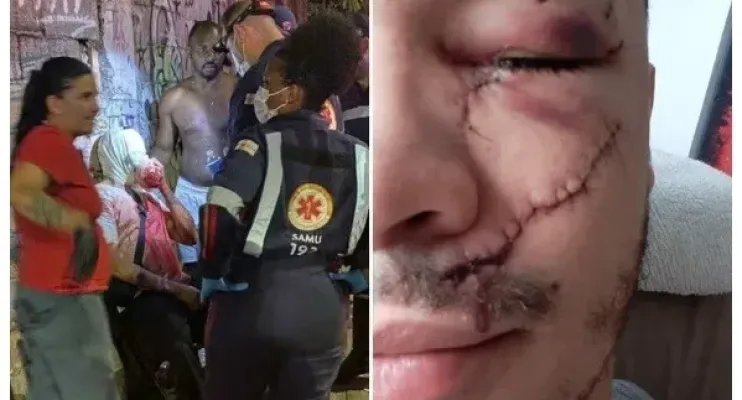 Jovem leva mais de 30 pontos no rosto após ser agredido com garrafa em bar