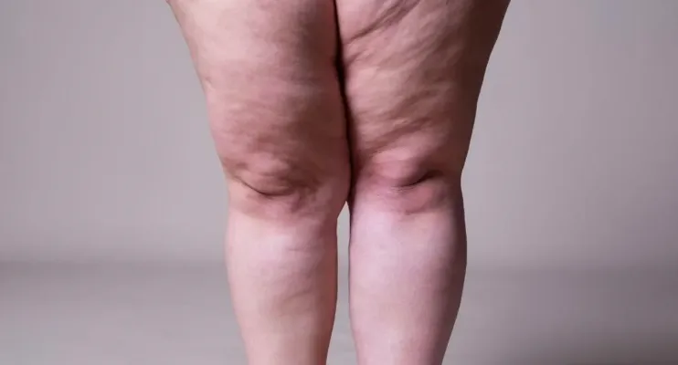 Lipedema: a doença que afeta a qualidade de vida de mais de 10 milhões de mulheres no Brasil