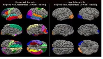 Lockdown acelerou envelhecimento cerebral das adolescentes em até 4 anos