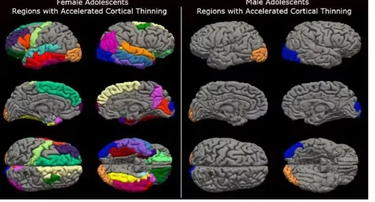  Lockdown acelerou envelhecimento cerebral das adolescentes em até 4 anos