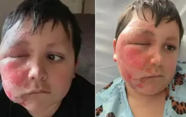 Menino faz desafio do TikTok e acaba com rosto desfigurado