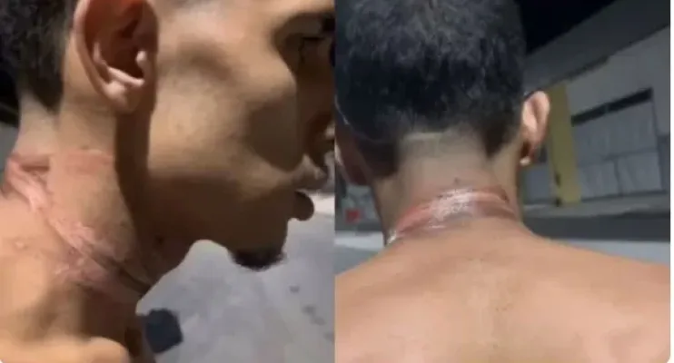  Motoboy sofre queimaduras no pescoço após se enrolar em fios soltos em Cariacica