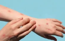 Mpox: veja como identificar sintomas e prevenir a transmissão doméstica