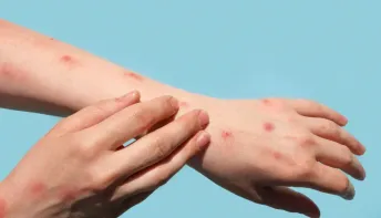 Mpox: veja como identificar sintomas e prevenir a transmissão doméstica