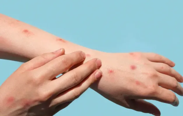 Mpox: veja como identificar sintomas e prevenir a transmissão doméstica