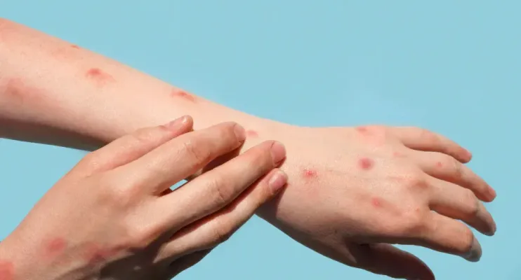 Mpox: veja como identificar sintomas e prevenir a transmissão doméstica