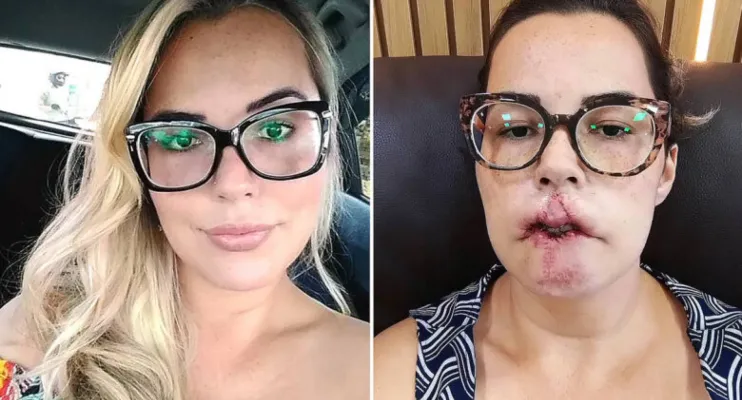 Mulher perde o lábio superior após fazer preenchimento com PMMA