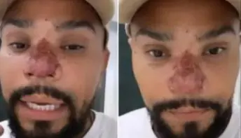 Naldo Benny sofre princípio de necrose no nariz com rinomodelação