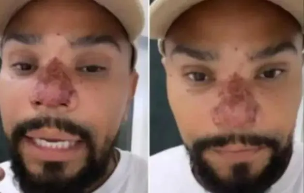 Naldo Benny sofre princípio de necrose no nariz com rinomodelação