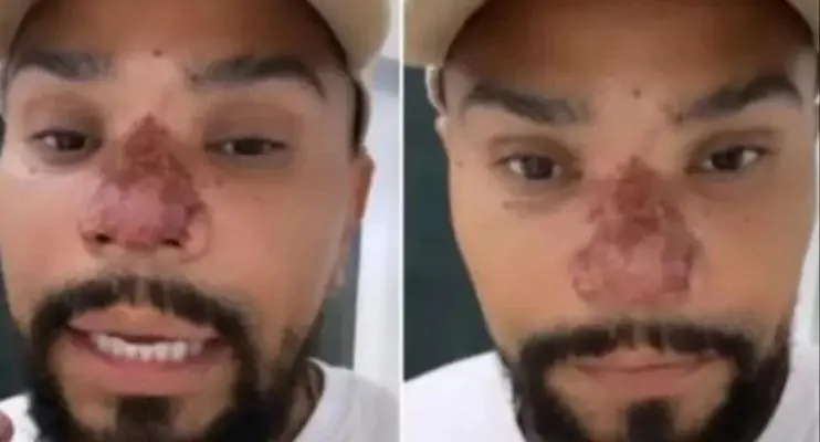 Naldo Benny sofre princípio de necrose no nariz com rinomodelação
