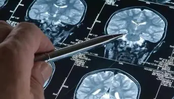 Novo remédio para Alzheimer reduz declínio cognitivo e é considerado ponto de virada para tratamento
