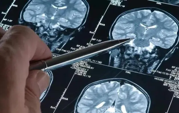 Novo remédio para Alzheimer reduz declínio cognitivo e é considerado ponto de virada para tratamento