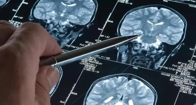Novo remédio para Alzheimer reduz declínio cognitivo e é considerado ponto de virada para tratamento