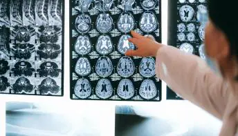 Os aneurismas cerebrais são mais comuns entre estas pessoas