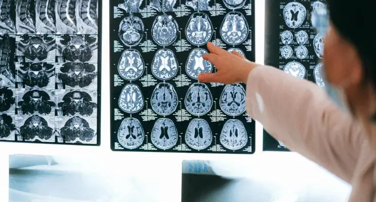 Os aneurismas cerebrais são mais comuns entre estas pessoas