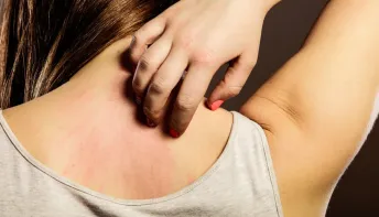 Picadas de insetos: como prevenir e agir em casos de reação alérgica