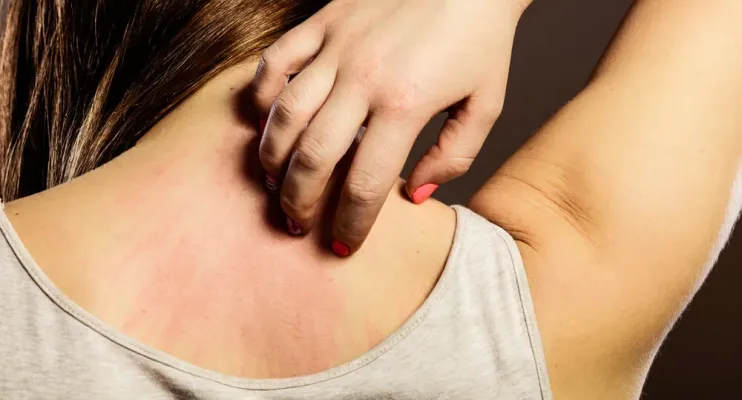 Picadas de insetos: como prevenir e agir em casos de reação alérgica