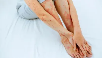 Psoríase: não é contagiosa, mas o estresse pode agravar o quadro