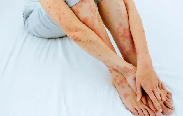 Psoríase: não é contagiosa, mas o estresse pode agravar o quadro