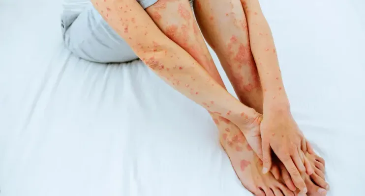 Psoríase: não é contagiosa, mas o estresse pode agravar o quadro