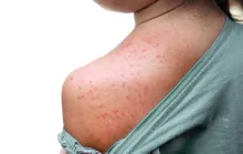 Quão perigoso é o sarampo? Sintomas para ficar de olho e como se proteger