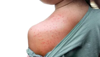 Quão perigoso é o sarampo? Sintomas para ficar de olho e como se proteger