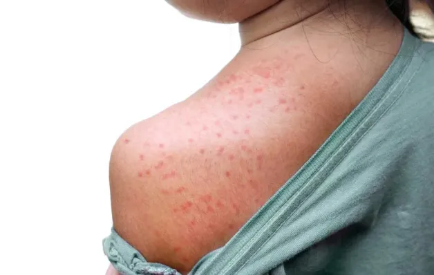 Quão perigoso é o sarampo? Sintomas para ficar de olho e como se proteger
