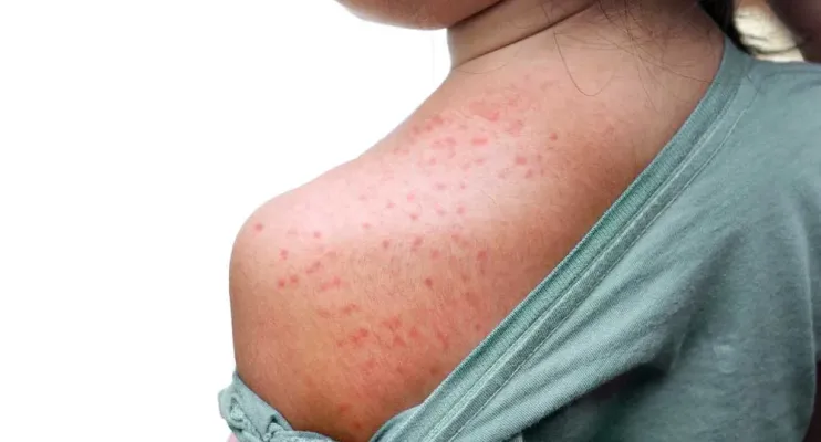 Quão perigoso é o sarampo? Sintomas para ficar de olho e como se proteger