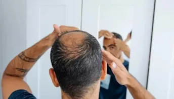 Queda de cabelo: conheça três doenças que afetam os seus fios