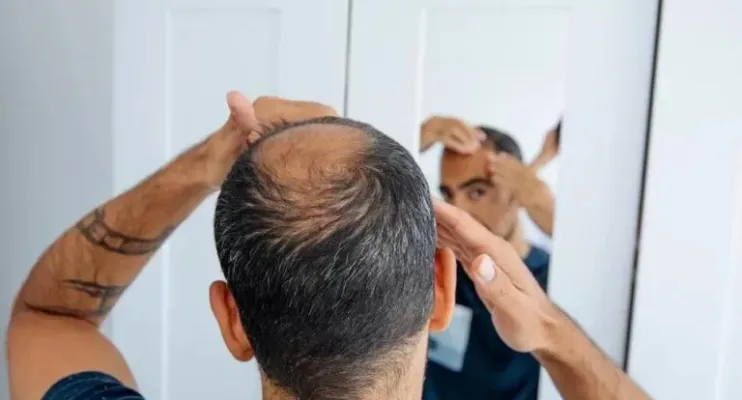 Queda de cabelo: conheça três doenças que afetam os seus fios