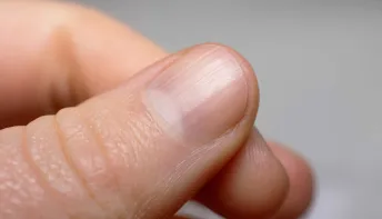 Sabe o que significam os pequenos relevos que tem nas unhas? Entenda!