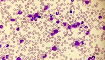Sintomas de leucemia mieloide crônica que todos precisam conhecer