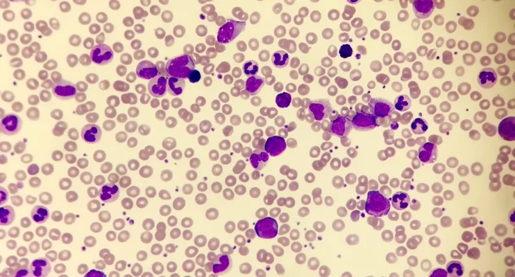 Sintomas de leucemia mieloide crônica que todos precisam conhecer