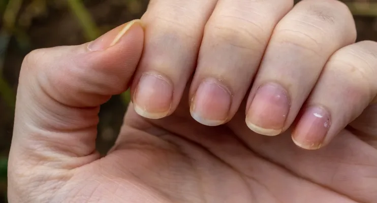 Tem sempre as unhas amareladas? É assim que deve tratá-las