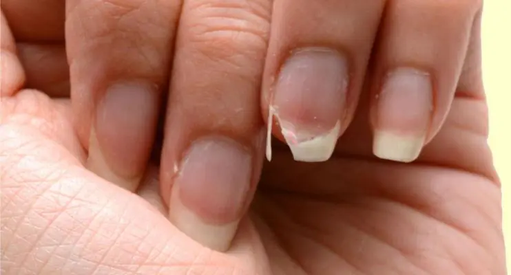 Unhas fracas e quebradiças: 3 dicas para fortalecê-las 